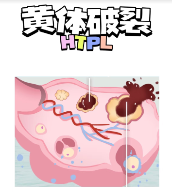警惕“隐形杀手”——黄体破裂!